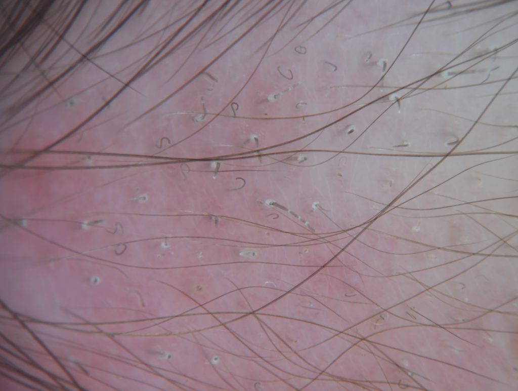 Nella tinea capitis, il parassitamento del pelo da parte dei miceti determina la rottura del fusto a differenti livelli, con l’insorgenza delle tipiche chiazze alopeciche.