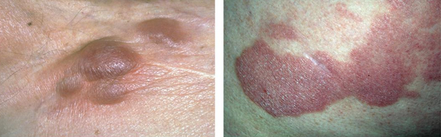 LC-OCT e microscopia confocale possono essere impiegate con risultati soddisfacenti in un vasto numero di patologie cutanee. In questo studio sono state analizzate 40 lesioni in 25 pazienti, suddivise tra linfomi a cellule T (CTCL) e a cellule B (CBCL, 25% della casisitica).