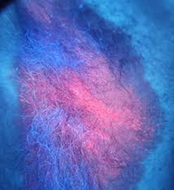 La dermoscopia classica può giovare dell’utilizzo di luce UV come metodica complementare nella diagnostica differenziale di lesioni non neoplastiche della cute.