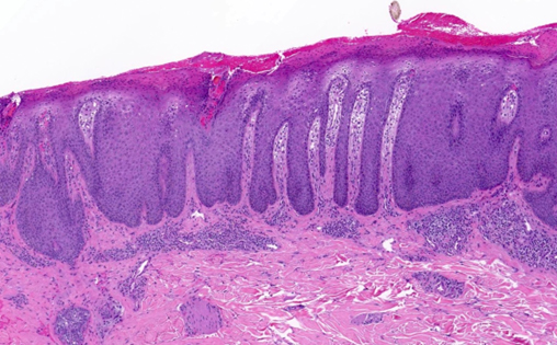 L’LC-OCT può essere di aiuto anche nella diagnosi di patologie cutanee infiammatorie, come ad esempio la psoriasi.