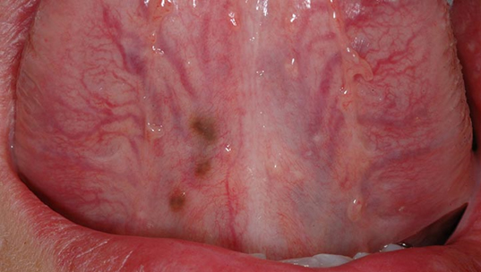 Le lesioni pigmentate delle mucose rappresentano un ambito di ricerca in forte evoluzione. In questo studio viene proposta una classificazione di tali lesioni basata sulla dermoscopia e sull’utilizzo della microscopia confocale con potenziali ricadute dal punto di vista del management clinico.