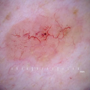 Il carcinoma basocellulare (BCC) rappresenta la neoplasia cutanea più diffusa e, specie nel distretto facciale, il suo accrescimento locale espone i pazienti a rischi di deficit anatomo-funzionali ed estetici.