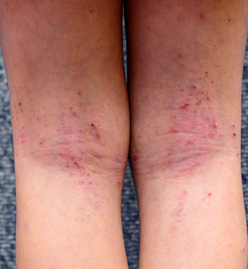 La gestione clinica della dermatite atopica (DA) di grado moderato-severo beneficia ampiamente di terapie biologiche avanzate come il dupilumab. Tuttavia, l'oggettivazione della risposta terapeutica si affida tradizionalmente a score clinici (es. EASI)...