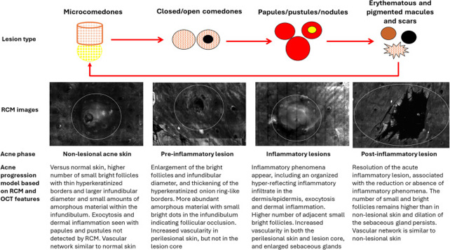 Le metodiche di imaging non invasivo ad alta risoluzione, come la microscopia confocale a riflettanza (RCM) e la tomografia a coerenza ottica (OCT), hanno progressivamente ampliato le nostre conoscenze sulle alterazioni morfologiche che caratterizzano il ciclo vitale delle lesioni acneiche.